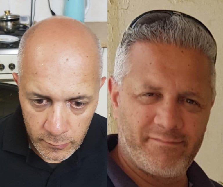 תמונות לפני ואחרי שתל שיער סינתטי.