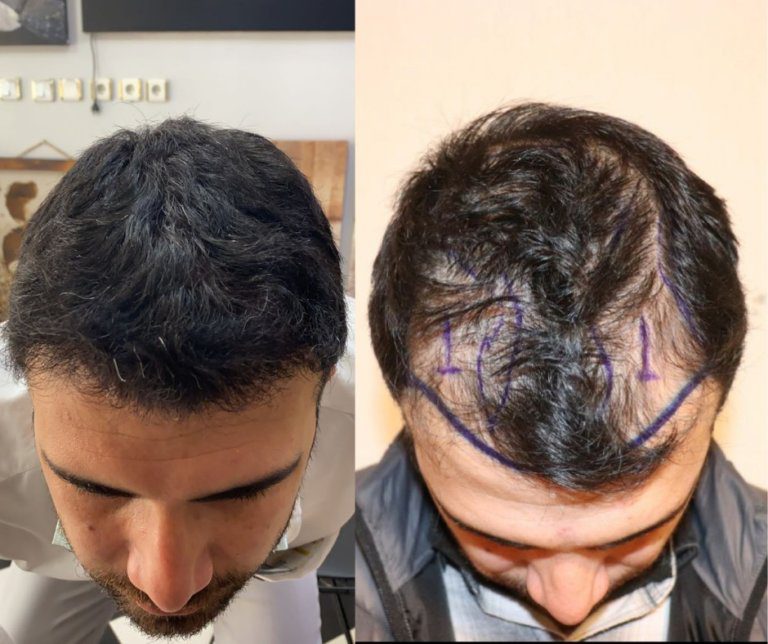 טיפול לקידום צמיחת שיער - לפני ואחרי.