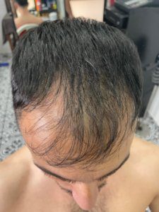 תוצאה של השתלת שיער