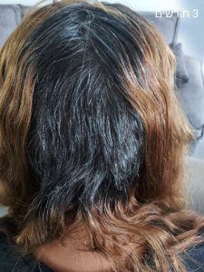 העלאת מודעות להשתלות שיער של נשים