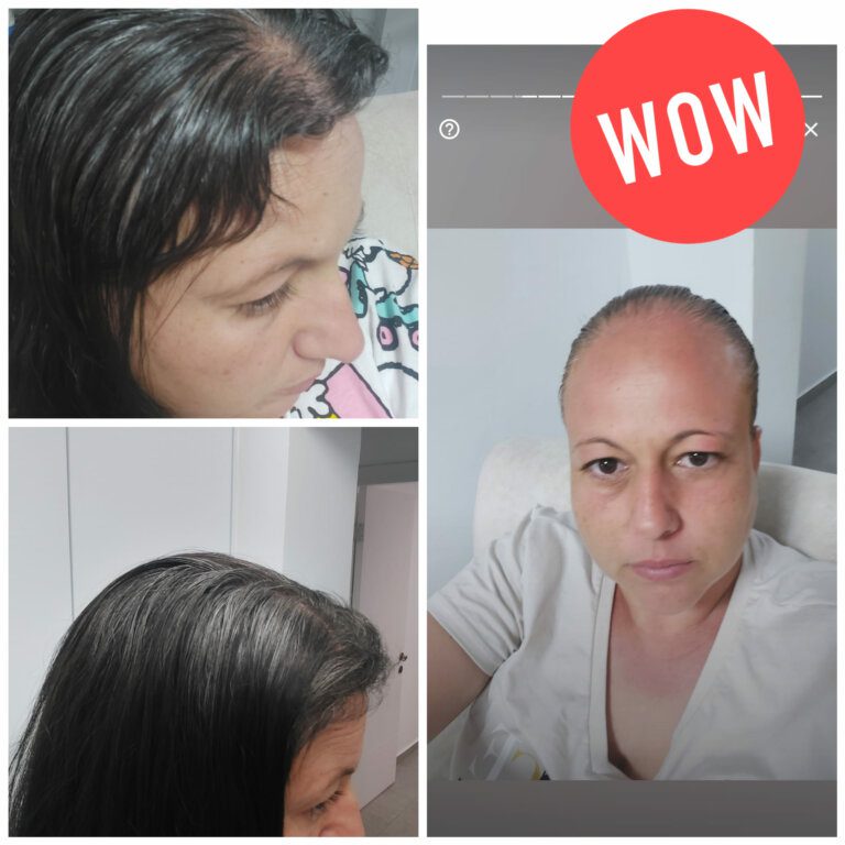 טיפול באובדן שיער - לפני ואחרי תוצאות